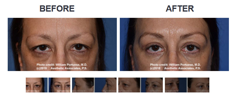 Cosmetic eyelid surgery 