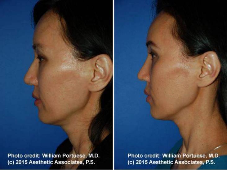 facial plastic surgery in Portland Oregon