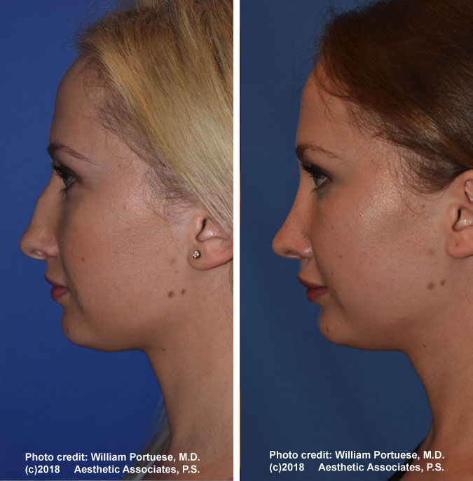 Rhinoplasty