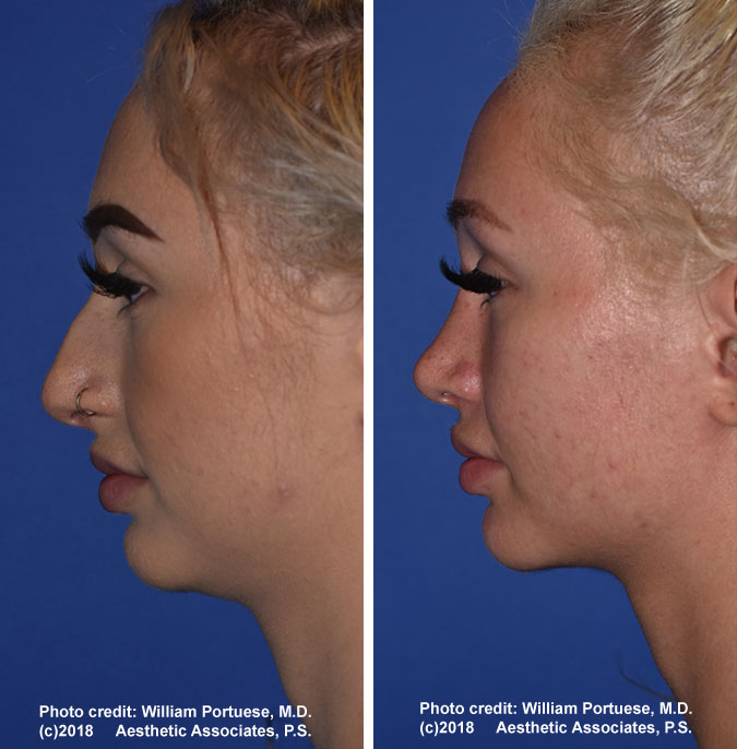 Nose Surgeon Portland Oregon