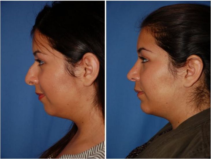 Pacific Northwest Rhinoplasty Surgeon