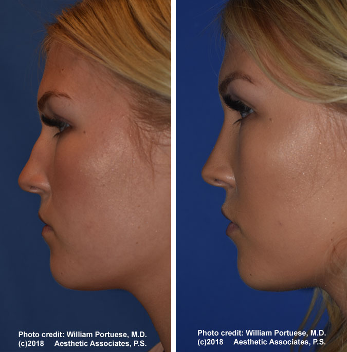 Portland Rhinoplasty Surgeon