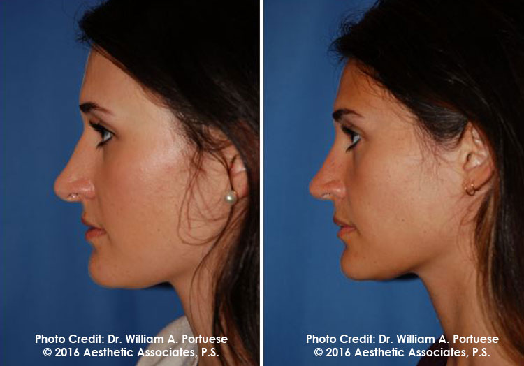 Rhinoplasty in Pacific Northwest