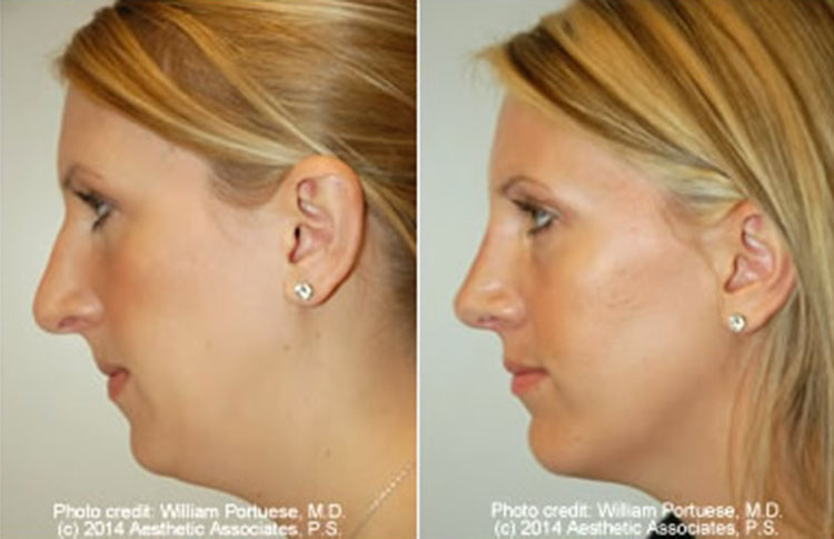 facial rejuventation treatments Portland Oregon