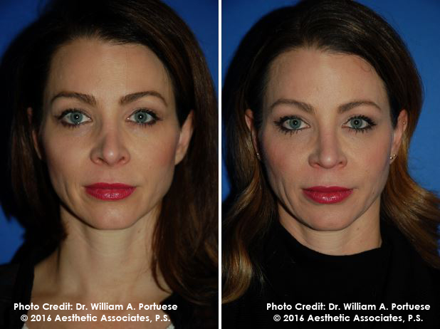 botox injections Portland Oregon