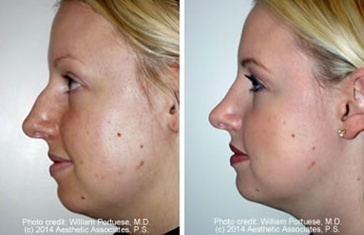 Rhinoplasty Surgery Pacific Northwest