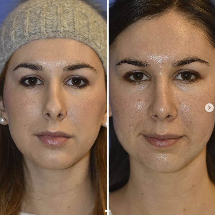nose tip reduction