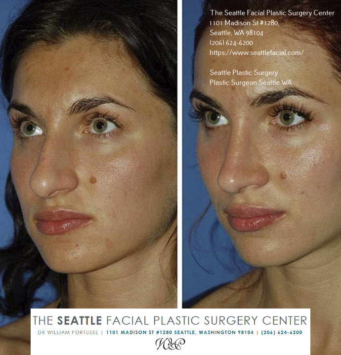 best rhinoplasty surgeon for bulbous tip