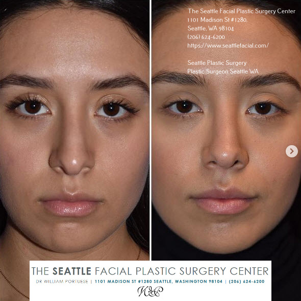 how much is a nose job seattle