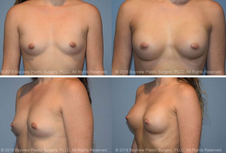 Breast Augmentation Surgeons