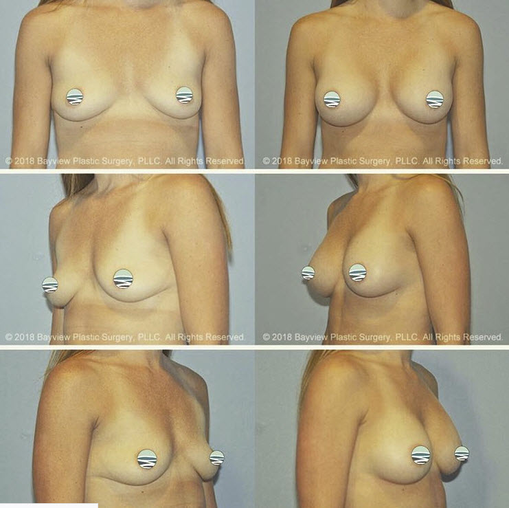 breast implant surgery cost