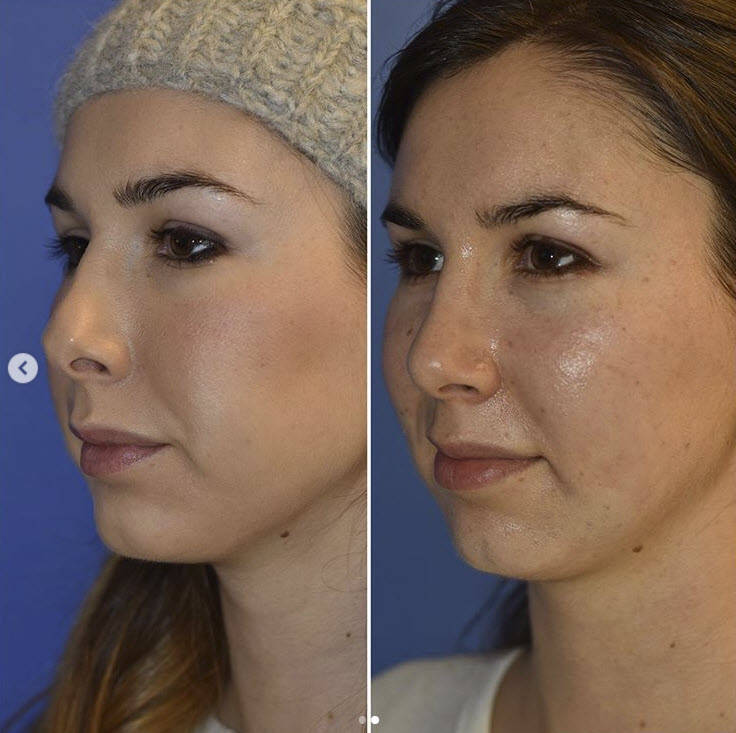 Consider a Facelift in Seattle