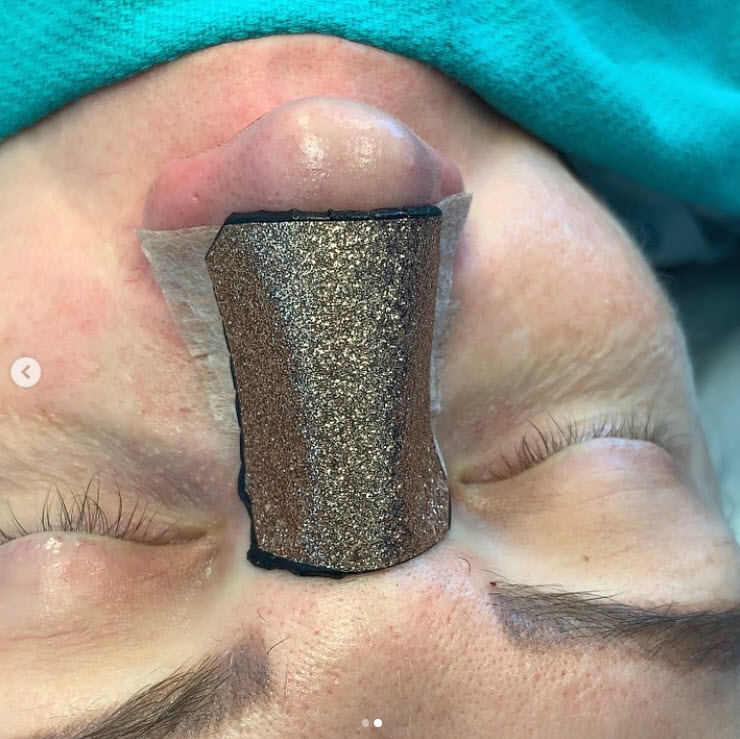 seattle facial rhinoplasty