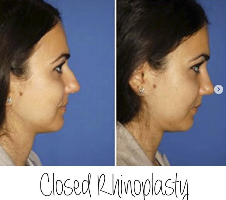 Facelift Surgery Recovery